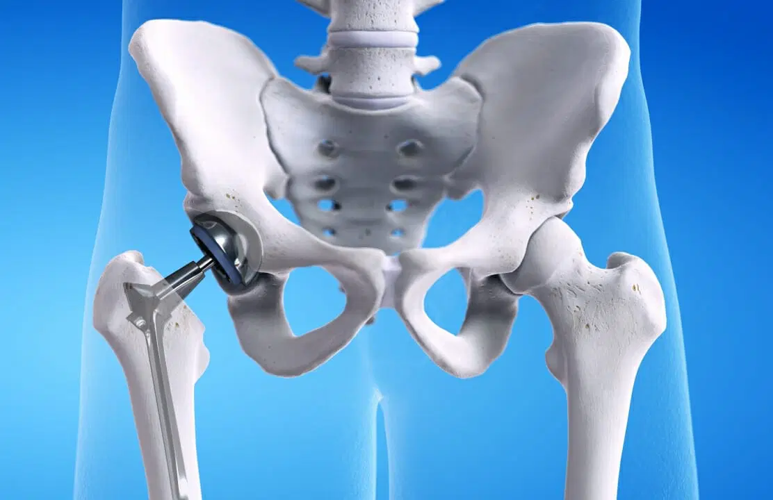 Hip implants