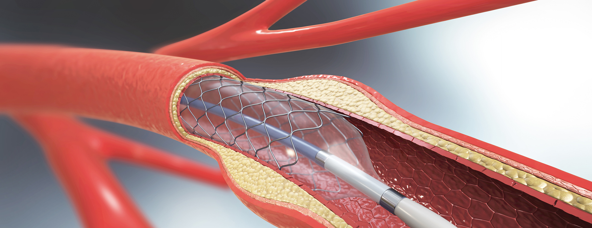 Coronary stents